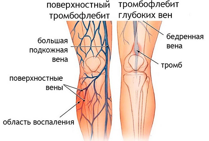 Тромбофлебит вен