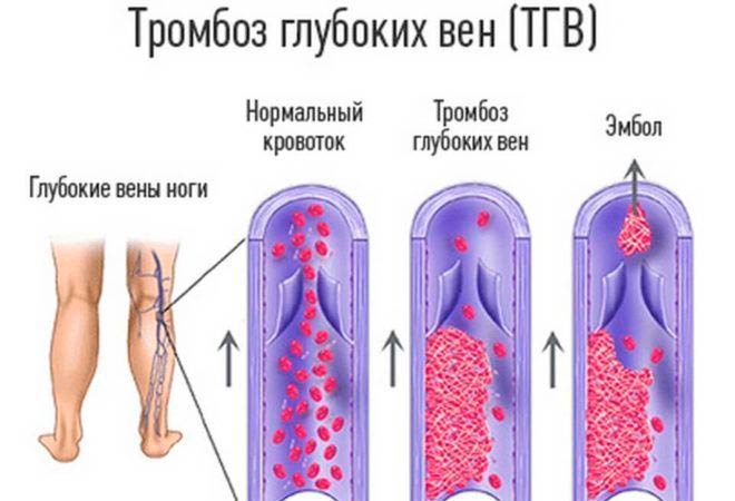Тромбоз глубоких вен